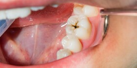 ۷ نکته ساده برای جلوگیری از پوسیدگی دندان‌ها