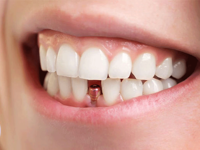 همه چیز درباره ایمپلنت دندان