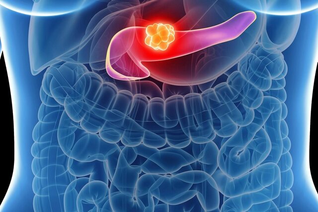 سرطان پانکراس در موش‌ها با کمک فناوری‌نانو بهبود امیدوارکننده‌ای یافت