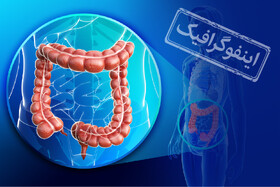 اینفوگرافیک / تشخیص زودهنگام سرطان روده با پنج علامت