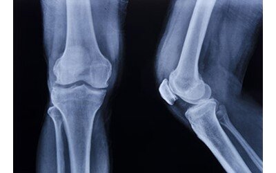 تولید نمونه حیوانی "داربست استخوانی با سلول بنیادی"/ ترمیم استخوان با سلول های بنیادی