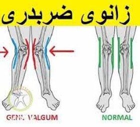 انحراف زانو باعث سائیدگی و تخریب مفصل می‌شود