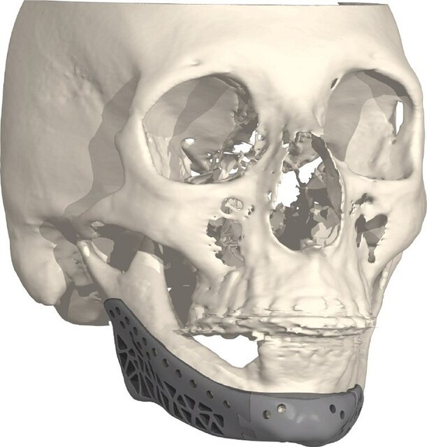 ارائه پروتزهای سفارشی جراحی‌های ارتوپدی و فک و صورت با پرینترهای سه‌بعدی