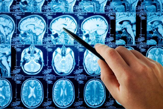 افزایش امنیت هوش مصنوعی در تحلیل MRI مغز با راه حل پژوهشگران دانشگاهی