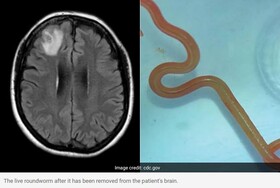 کشف کرم زنده در مغز بیمار استرالیایی/نگرانی پزشکان از رشد امراض مشترک بین انسان و حیوان