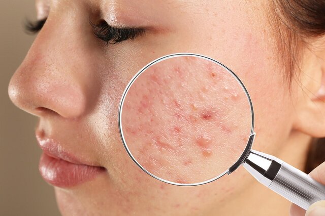 چند راز پوست قشنگها برای جوش نزدن صورتشان چند راز پوست قشنگها برای جوش نزدن صورتشان