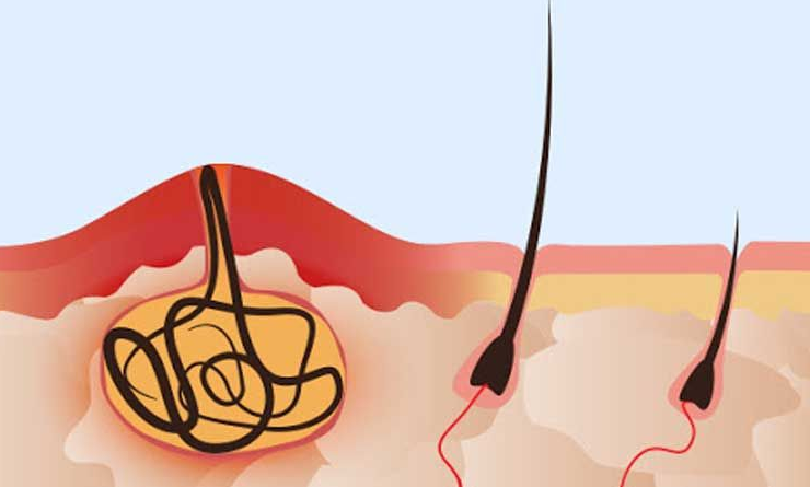 مراقبتهای بعد عمل کیست مویی کدام است؟