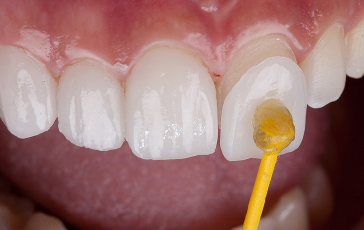 چرا قیمت لمینت دندان زیاد است؟