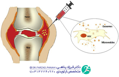 درمان غیر جراحی زانو درد با اگزوزوم‌تراپی