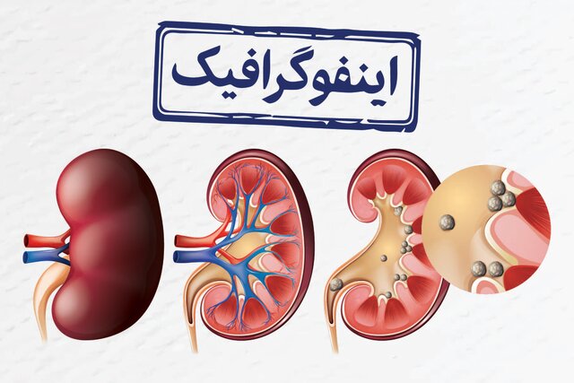 اینفوگرافیک/ ۸ عادت غلط که سبب بروز سنگ کلیه می‌شود