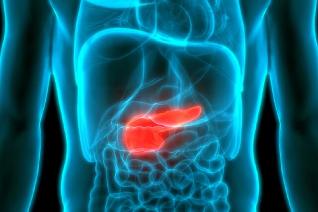 تایید ارتباط سطح بالای انسولین خون با سرطان لوزالمعده تایید ارتباط سطح بالای انسولین خون با سرطان لوزالمعده