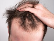 ماینوکسیدیل خوراکی برای ریزش موی مردانه موثرتر است