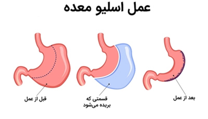 آیا اسلیو سریعترین راه لاغری شکم و پهلو است؟