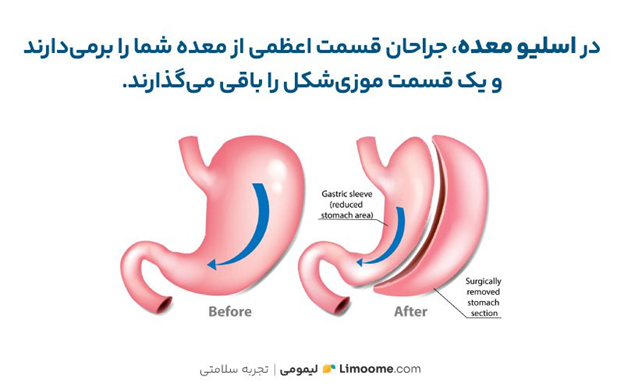 انواع عمل لاغری؛ سیر تا پیاز کاهش وزن به روش مدرن
