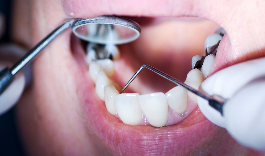 زیبایی و سلامت دندانها با گوتا، امالکپ و کامپوزیت