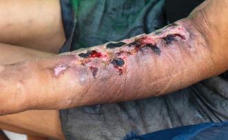 مخدر «زامبی» تهدیدی نوظهور؛ فوت مصرفکنندگان بعد از اوردوز