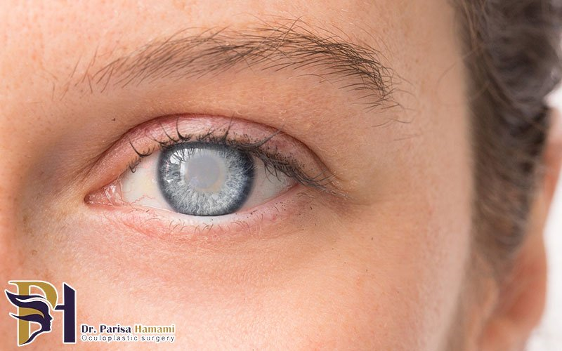 چگونه از ابتلا به آب مروارید چشم جلوگیری کنیم؟