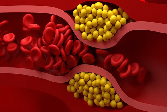کاهش ۳۰ درصدی کلسترول بد خون با یک واکسن کاهش ۳۰ درصدی کلسترول بد خون با یک واکسن