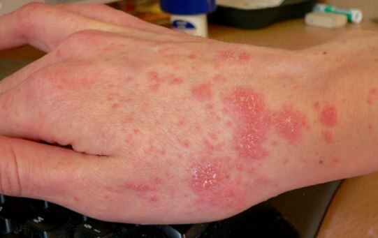 شیوع یک بیماری واگیردار در انگلیس؛ متخصصان نگران کمبود دارو هستند