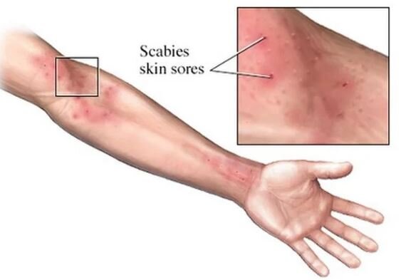 شیوع یک بیماری واگیردار در انگلیس؛ متخصصان نگران کمبود دارو هستند