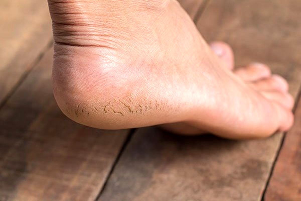 درمان ترک پا در خانه