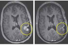 یک درمان جدید تومور مغزی را در عرض تنها ۵ روز از بین برد