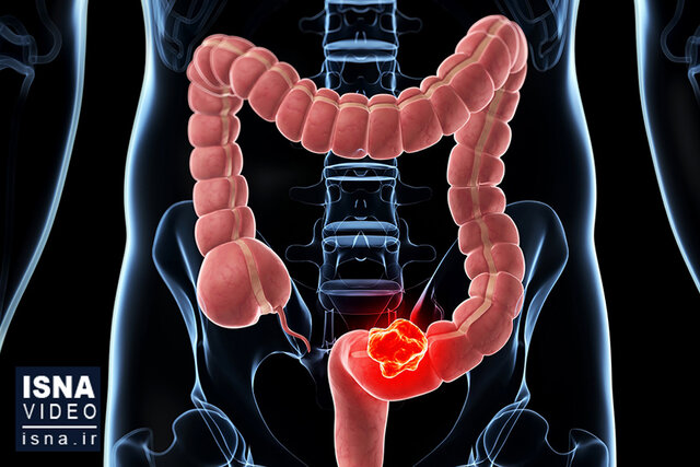 ویدیو/ یک «اشتباه ساده» و خطر ابتلا به سرطان روده بزرگ ویدیو/ یک «اشتباه ساده» و خطر ابتلا به سرطان روده بزرگ