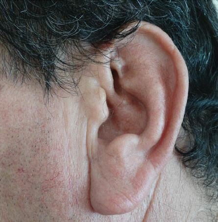 چند توصیه برای باز کردن گرفتگی گوش چند توصیه برای باز کردن گرفتگی گوش