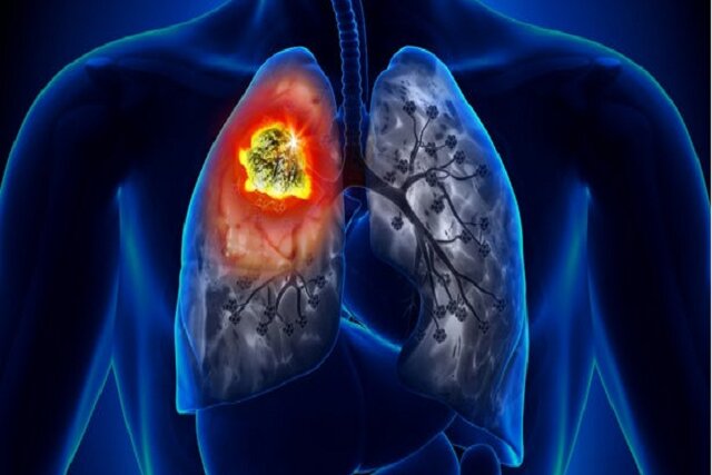 راهکار نانویی برای از بین بردن عفونتهای ریوی مقاوم در برابر دارو راهکار نانویی برای از بین بردن عفونتهای ریوی مقاوم در برابر دارو