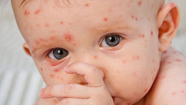 همهچیز در مورد یک ویروس بهاری همهچیز در مورد یک ویروس بهاری