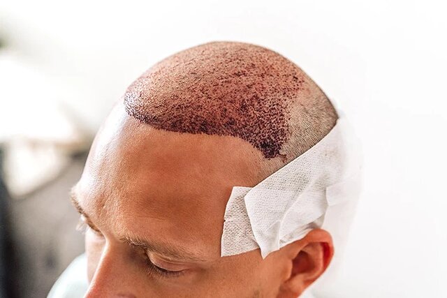 آشنایی با عوارض خطرناک کاشت مو که به شما نمیگویند آشنایی با عوارض خطرناک کاشت مو که به شما نمیگویند