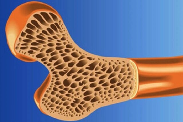 پوکی استخوان، معضل جدی سیستم سلامت عمومی و بهداشت سالمندان