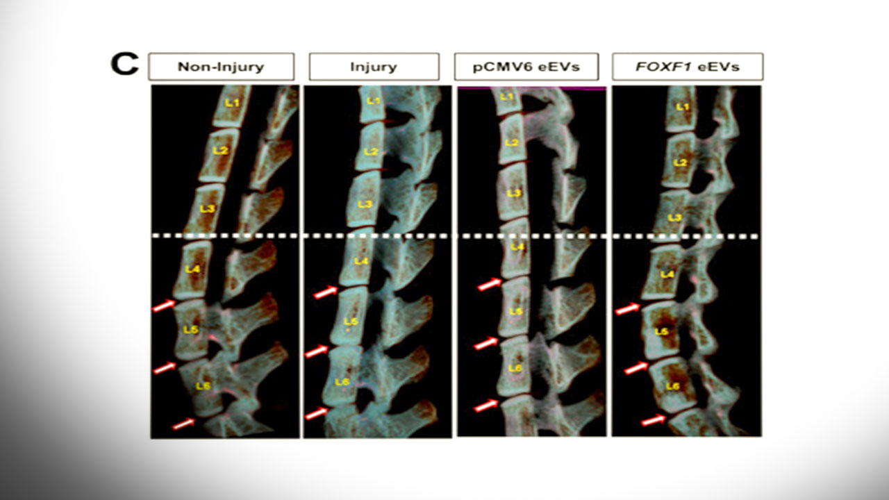 دیسک کمر با کمک فناورینانو قابل درمان میشود