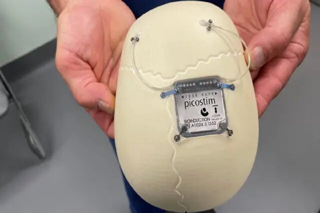 اولین ایمپلنت کنترل صرع در جهان تشنج را تا ۸۰ درصد کاهش داد اولین ایمپلنت کنترل صرع در جهان تشنج را تا ۸۰ درصد کاهش داد