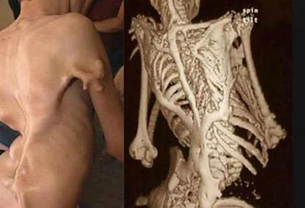 ۸ مورد از نادرترین بیماریهای جهان؛ از سندرم دست بیگانه تا سندرم مُرده متحرک