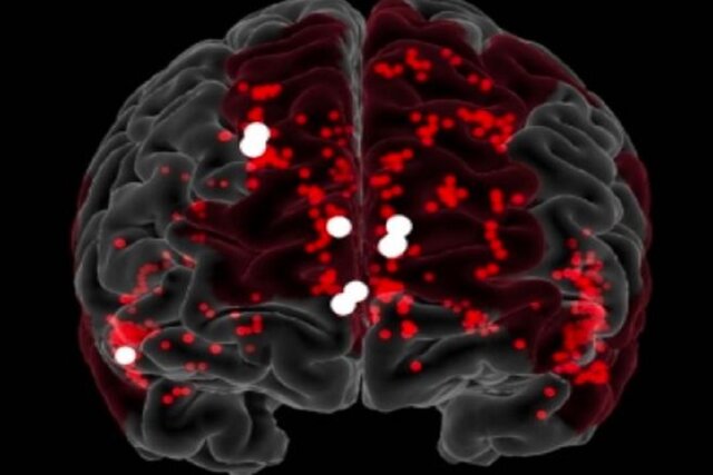 نانورباتها با موفقیت خونریزی مغز را متوقف کردند نانورباتها با موفقیت خونریزی مغز را متوقف کردند