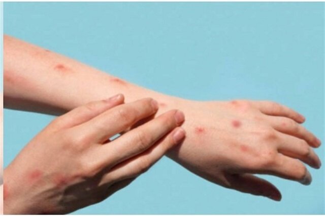 عکس تزیینی است. بررسی آخرین یافتههای علمی در مدیریت شیوع بیماریهای تب دنگی و آبله میمون