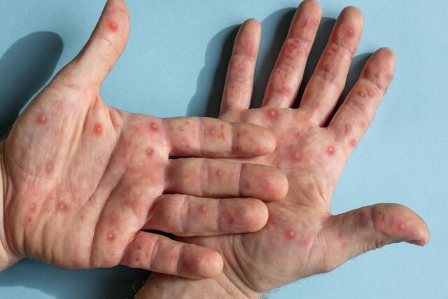 ارتباط مشکوک ویروس آبله میمون و اختلال در باروری مردان ارتباط مشکوک ویروس آبله میمون و اختلال در باروری مردان