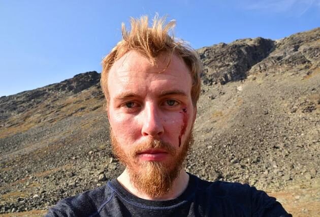 فرانسیس استور، ۳۱ ساله که عقاب دستکم ششبار متوالی به او حمله کرد حمله یک عقاب به چندین نفر در نروژ