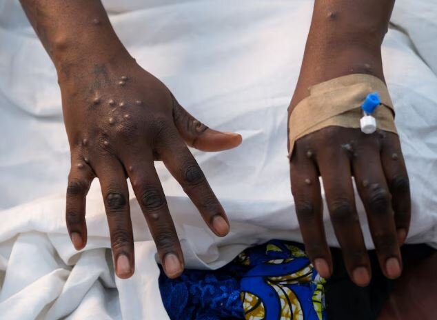 عکس: رویترز حدود ۳۰ هزار مورد مشکوک «آبله میمونی» در سال جاری در آفریقا ثبت شده است