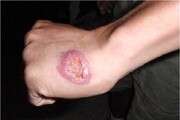 کاهش ۷۵ درصدی بروز سالک در خراسان شمالی