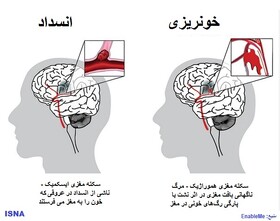 اصلی‌ترین عاملِ خطِر سکته مغزی در همه کشورها یکسان است