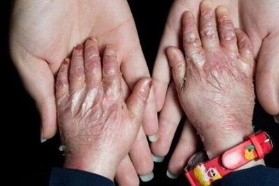 پانسمان حیاتی بیماران پروانهای در فهرست تحریمهاست / هیچ کودک پروانهای نباید از تحصیل بازبماند پانسمان حیاتی بیماران پروانهای در فهرست تحریمهاست / هیچ کودک پروانهای نباید از تحصیل بازبماند