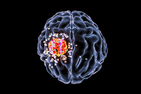 موفقیت یک کاوشگر جدید در تشخیص متاستاز سرطان مغز