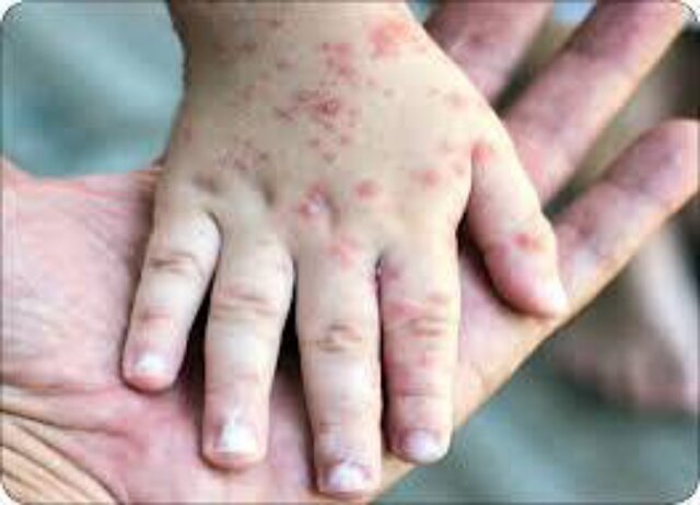 عکس تزیینی است. عوارض بروز آبلهمرغان در بزرگسالی / توصیه تزریق واکسن در گروههای پرخطر