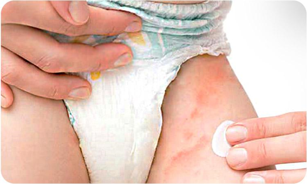 عوارض دیر عوض کردن پوشک بچه چیست/ بررسی مهمترین عوارض