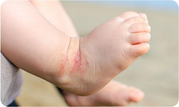 عوارض دیر عوض کردن پوشک بچه چیست/ بررسی مهمترین عوارض