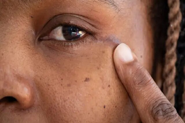 جراحی تومور مغزی از طریق چشم برای اولین بار در بریتانیا جراحی تومور مغزی از طریق چشم برای اولین بار در بریتانیا