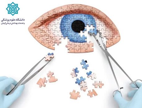 اولین عمل جراحی ایجاد پنجره روی غلاف اعصاب بینایی در کرمان