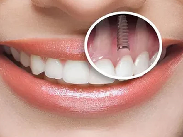 ایمپلنت دندان بهتر است یا عصب کشی دندان